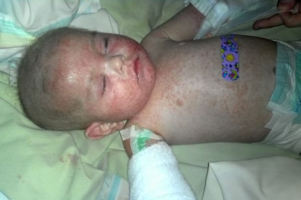 3 PAY-Isaiah-Quinn-baby-with-skin-condition